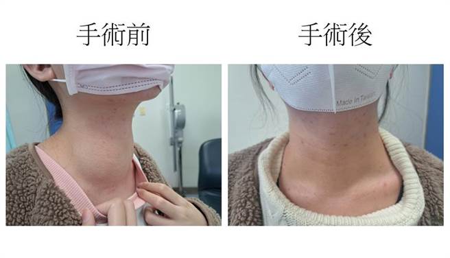 医师先以药物调整2周并配合血管栓塞，再施以无痕经口甲状腺双侧切除与术中无线电热烧灼手术，不但不留疤还能大啖海鲜。（大里仁爱医院提供／潘虹恩台中传真）