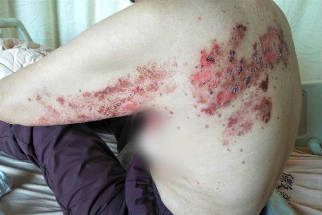 病毒沿着神经节长出带状水泡状疱疹。（台中慈济医院提供）