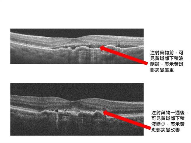 注射新藥前後差異。（亞東醫院提供）