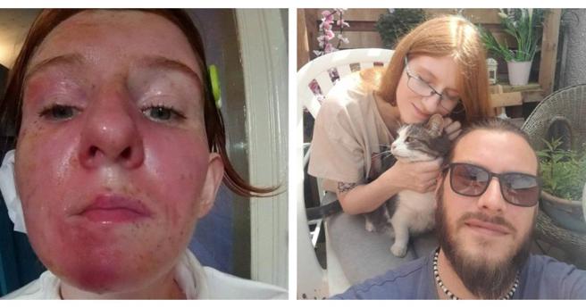 女子遭未来的小叔泼热水，造成脸部二级烧伤，女子的雀斑甚至被烫到掉落。（图／当事人提供）