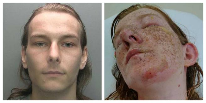 女子遭未来的小叔泼热水，造成脸部二级烧伤，女子的雀斑甚至被烫到掉落。（图／当事人提供）