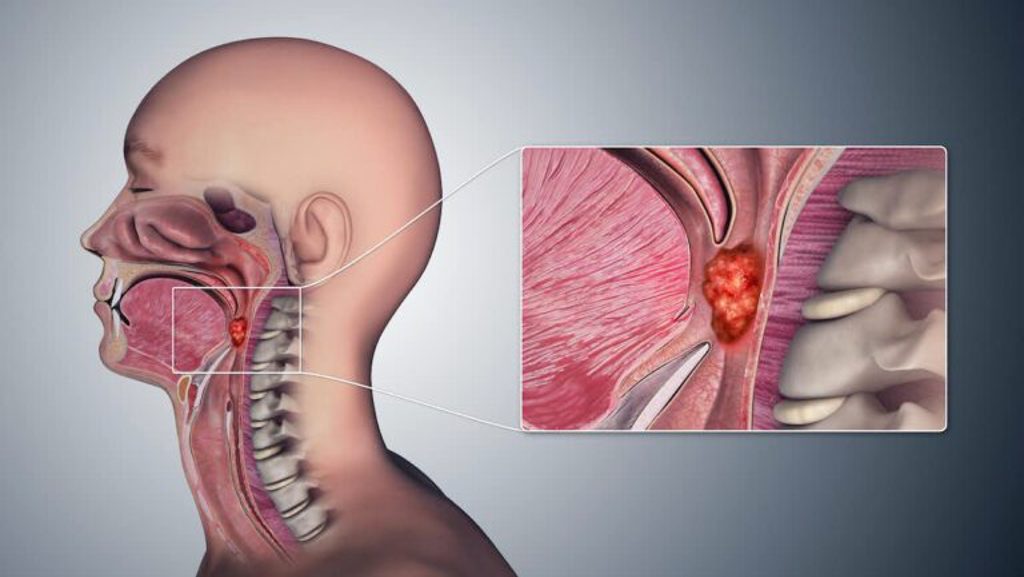 咽喉癌发生在扁桃体和喉咙后部的区域，此处组织与子宫颈一样柔弱。图/WIKI(photo:ChinaTimes)