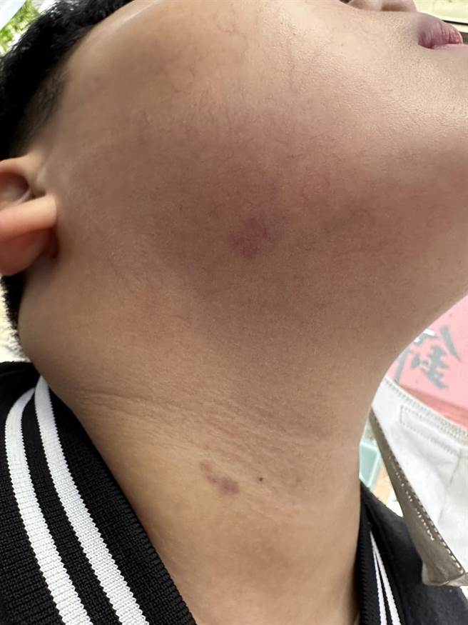 台中市大里区一间国小六男童遭男老师掐衣领去撞墙，导致头、脸、四肢多处瘀青挫伤。（江和树提供）