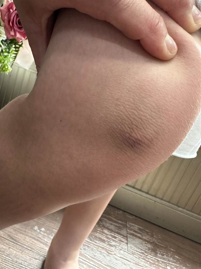 台中市大里区一间国小六男童遭男老师掐衣领去撞墙，导致头、脸、四肢多处瘀青挫伤。（江和树提供）