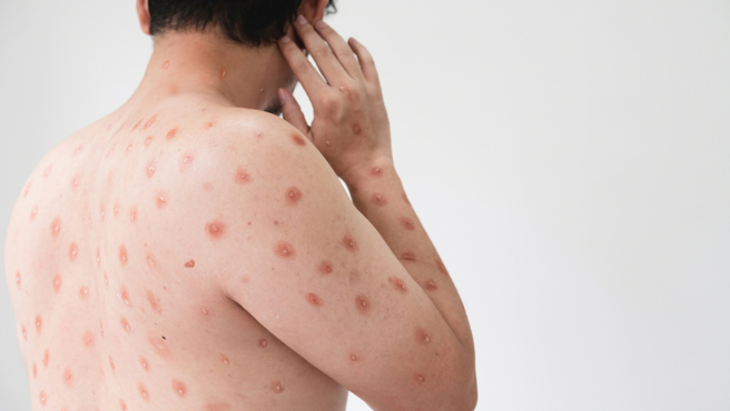 全台猴痘再增12例，其中又以新北6例占最多，确诊病例中首见60多岁男确诊。（图／示意图，达志影像）