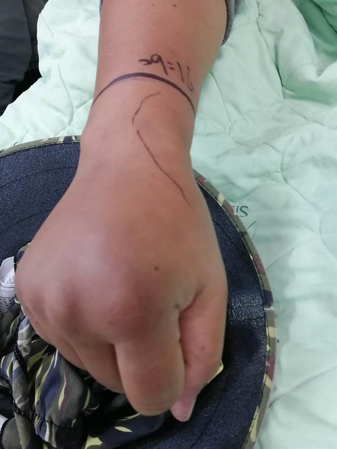 赤尾青竹丝属出血性毒蛇，女子右手遭咬伤后不久即瘀青、肿胀。（竹山秀传医院提供／杨静茹南投传真）