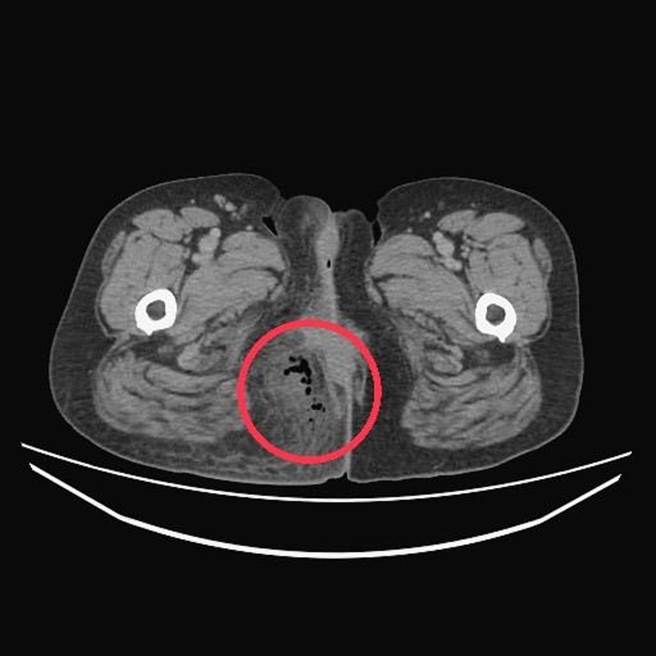 台中55岁阿秀日前因误吞3公分鱼刺，造成鱼刺卡在肛门周边组织，红肿疼痛不止。（台中医院提供／潘虹恩台中传真）