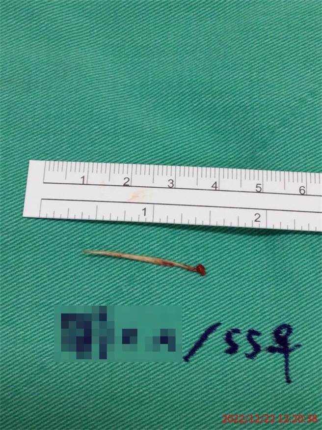 阿秀当时因未习惯新做好的假牙，导致她在饮食时，对异物的敏感度降低许多而误吞下3公分的鱼刺。（台中医院提供／潘虹恩台中传真）