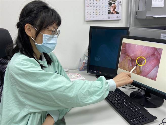 因巧克力囊肿导致病人骨盆腔内有严重沾黏的情形，建议民眾若有骨盆腔疼痛、排便疼痛等症状，应及早就医检查。（新竹台大分院提供／邱立雅竹县传真）