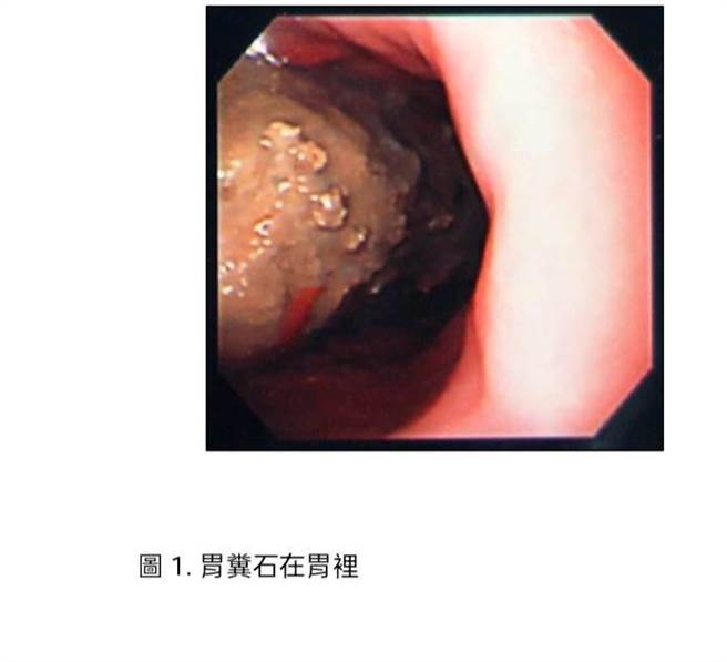 胃粪石在胃里。（北荣新竹分院提供／邱立雅竹县传真）