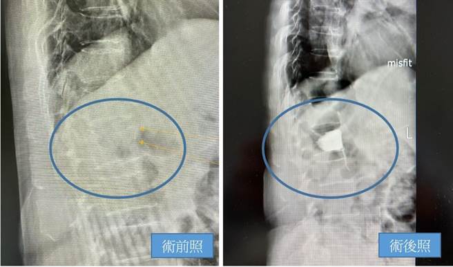 76岁吴阿嬷日前拜拜不慎跌倒导致左侧臀部疼痛及鼠蹊部不适，经骨盆摄影及脊椎X光检查发现她是脊椎压迫性骨折，幸採用骨水泥椎体成形术治疗顺利恢復。（长安医院提供／潘虹恩台中报导）