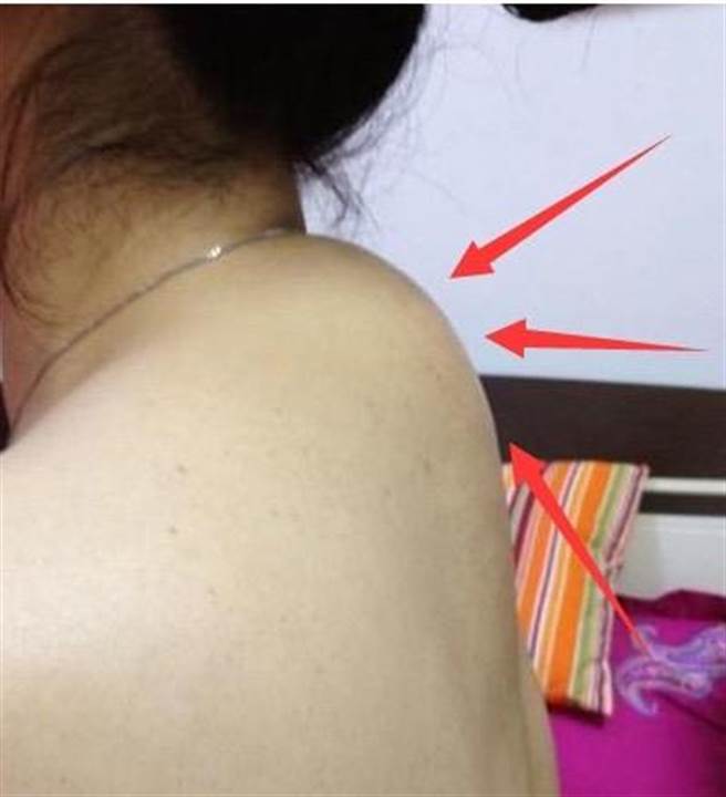 中医师提醒，颈椎有富贵包，小心是「脑梗」的前兆。（刘恩劭提供）