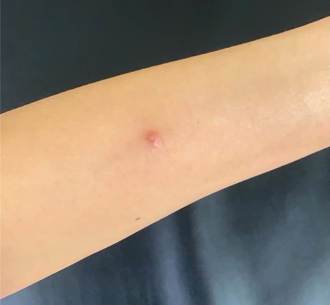 蚊子叮腫成「麵龜」塗止癢液 醫：這症狀建議停用