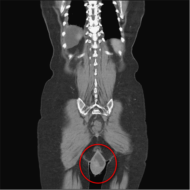 刘太太因腹腔压力过大，导致骨盆腔中的阴道脱垂。（台中医院提供／张亦惠台中传真）