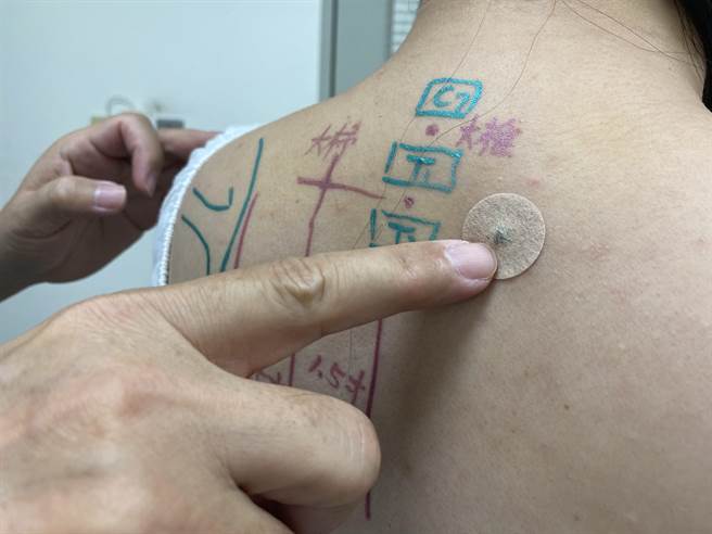 林常江示范于大杍穴位贴上磁力贴，可促进钙质吸收。（曹婷婷摄）