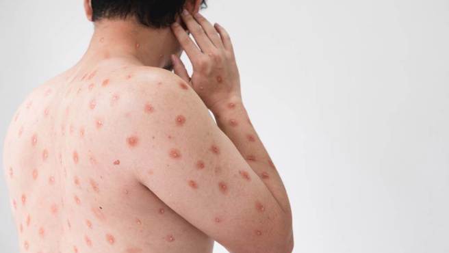 香港通报一名男子确诊猴痘，他上个月曾到访台湾一周。（示意图／达志影像shutterstock）