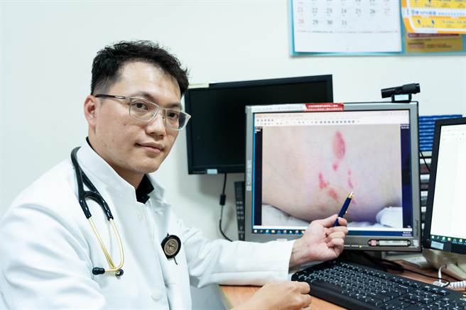 光田医院家医科医师吴健琳表示，罹患带状疱疹后很难完全根治，日常生活应多注意健康提升免疫力，也建议施打带状疱疹疫苗加以预防。（陈淑娥摄）