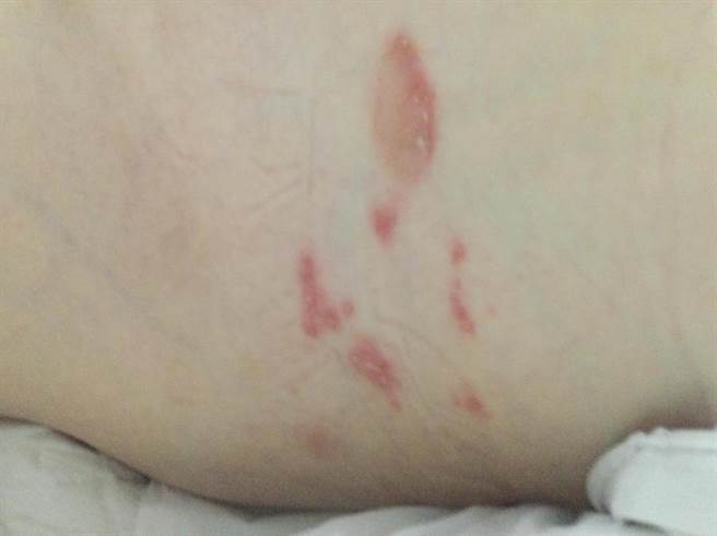 患者腰侧疼痛，后来开始有麻木感，接着腰部周围长出红斑，继而长出水疱范围扩大，属典型带状疱疹症状。（光田医院提供）