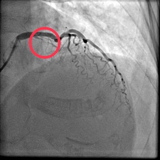 急性冠心症容易危及患者生命。（部立苗栗医院提供／谢明俊苗栗传真）