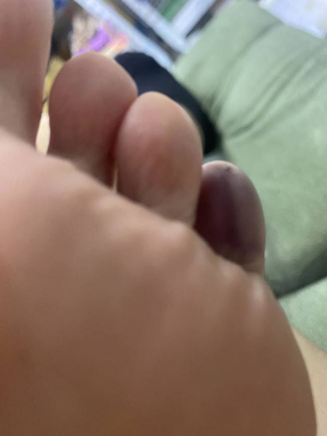 罗巧伦的脚小拇指呈现紫黑色。(图/罗巧伦 FB)