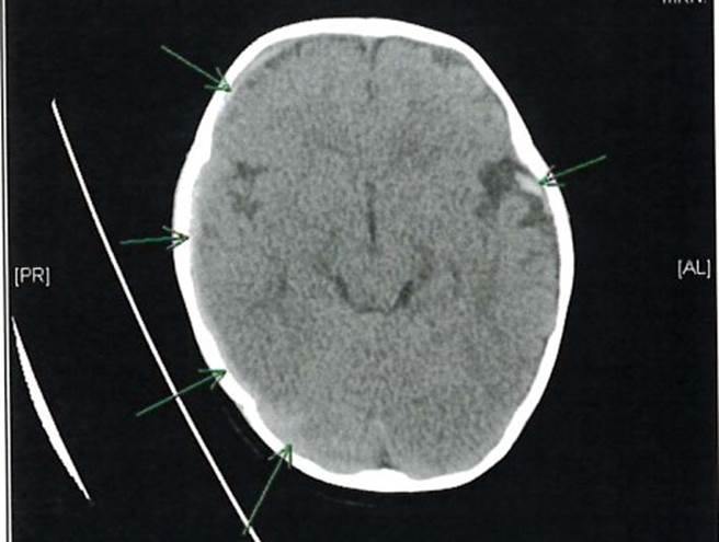 男婴遭保母重摔，造成脑部及视力永久性伤害。(屏检提供)