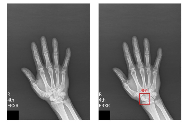 腕部舟状骨骨折软体侦测，医疗影像输入(图左)由软体标示出异常骨折(图右)处，俱备即时提示骨折处。( 图/ 长庚医院提供)