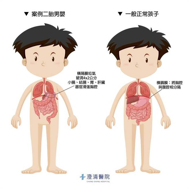 40岁妇人2年前怀孕产检发现胎儿罹「先天性横隔膜疝气」，部分的小肠、大肠、胃和肝臟滑进胸腔，医护团队接生后及时修补，如今孩童已平安长到2岁。（澄清中港院区提供／潘虹恩台中传真）