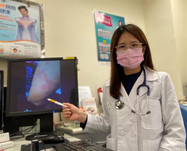 周孜容提醒，病灶在结痂前皆有传染力，应避免他人直接接触病灶。（新竹台大提供／王惠慧新竹传真）