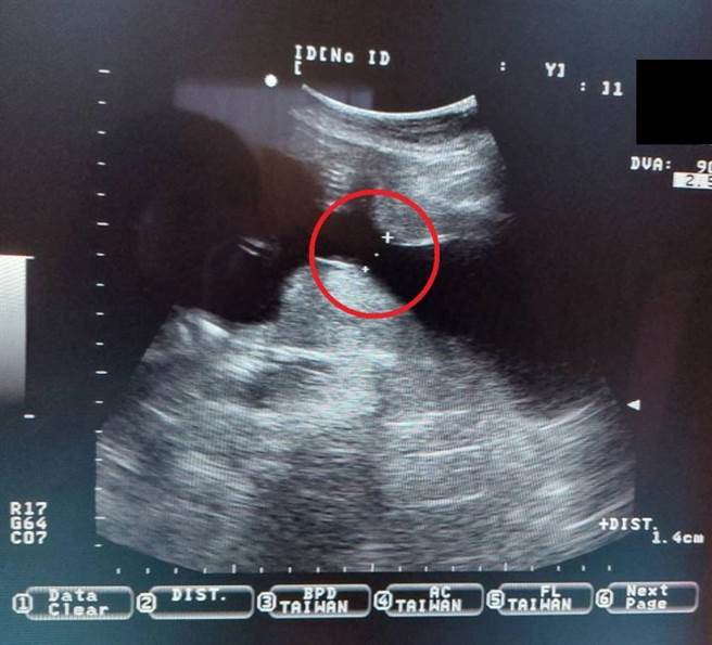子宮頸閉鎖不全的狀況，在超音波檢查下，可以清楚發現子宮頸已提早擴張(紅圈處)。（大千醫院提供／李京昇苗栗傳真）