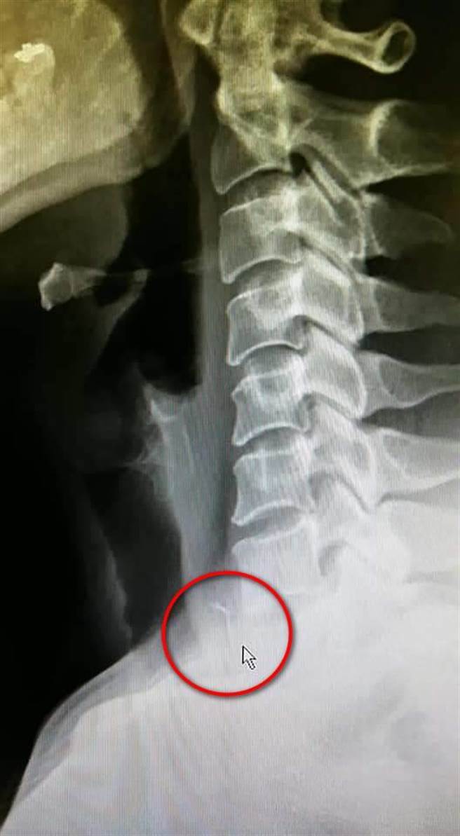 花莲一名70多岁的陈姓老翁因食道卡了2公分的鱼刺，深夜感到喉咙不适，后经医师进行食道镜手术取出后，解决鱼刺卡喉危机。（花莲慈济医院提供／罗亦晽花莲传真）