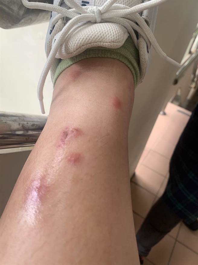 图为中山国中学生被跳蚤叮的满脚包情形。（施伟政办公室提供／徐佑升基隆传真）