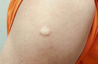 桃園猴痘感染累積19例 衛生局籲：高風險族群速接種疫苗