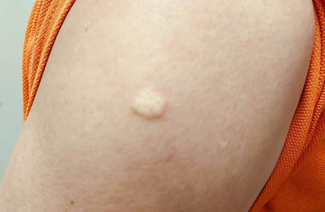 桃园市感染猴痘人数至17日累积19例，确诊案例多数有高风险未保护性行为，桃园市卫生局呼吁高风险族群接种疫苗。（翻摄照片）