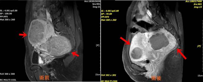 妇人子宫长两颗肌瘤，童综合实施无创海芙刀手术后已明显改善。（童综合提供）