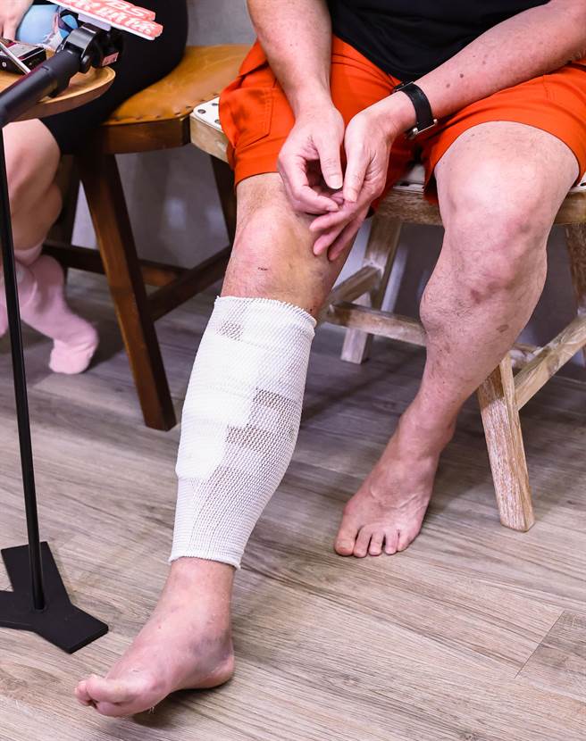 黄仲崑脚伤曝光。（罗永铭摄）