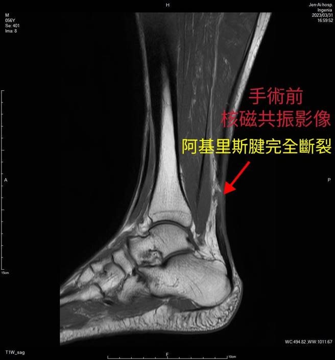 42岁王姓男子近期在羽毛球比赛中跳跃击球，未料落地后「啪」一声，右脚跟出现剧痛，几乎无法行走，立即就医发现竟是右脚「阿基里斯腱」断裂。（大里仁爱医院提供／潘虹恩台中传真）