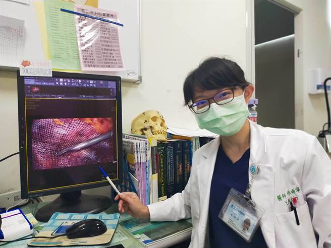 林雨寧医师指出，患者施行腹腔镜(微创)疝气手术，可使用自粘式人工网膜，降低术后疼痛不适感觉。（部苗医院提供／李京升苗栗传真）