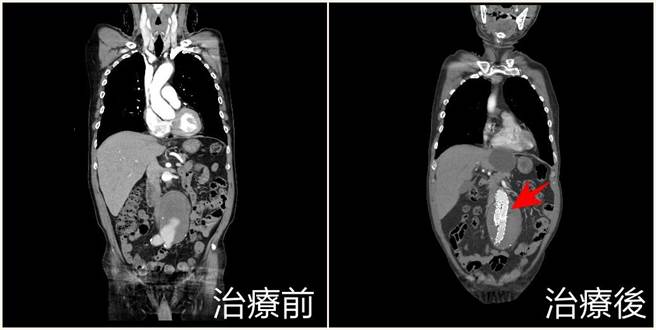 菸龄50多年黄姓老翁长出直径8公分的腹主动脉瘤以及明显主动脉弓剥离，经微创主动脉覆膜支架手术后成功恢復，术伤口仅约3至5公分甚至更小，对长者是一大福音。（亚大附医提供／潘虹恩台中传真）