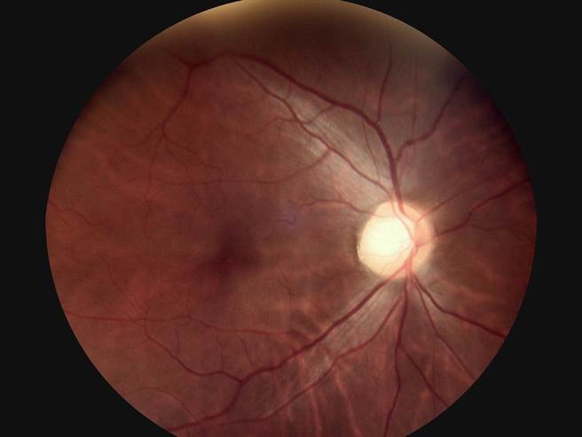 高龄老翁经眼底镜检查，发现患有白内障，随即启动绿色通道转诊治疗。(台东县政府提供／萧嘉蕙台东传真)