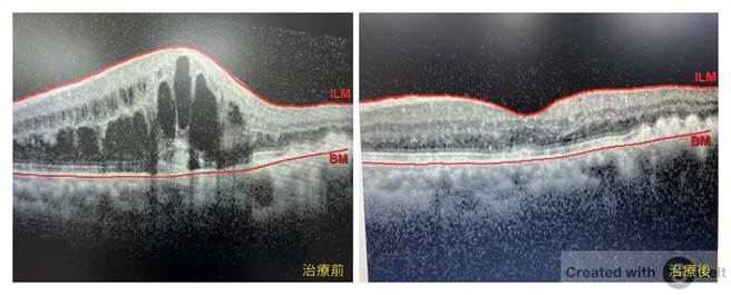 图为病患的黄斑部照，治疗前严重水肿，透过注射眼球内药物治疗，黄斑部很快就消肿了。（长安医院提供／冯惠宜台中传真）