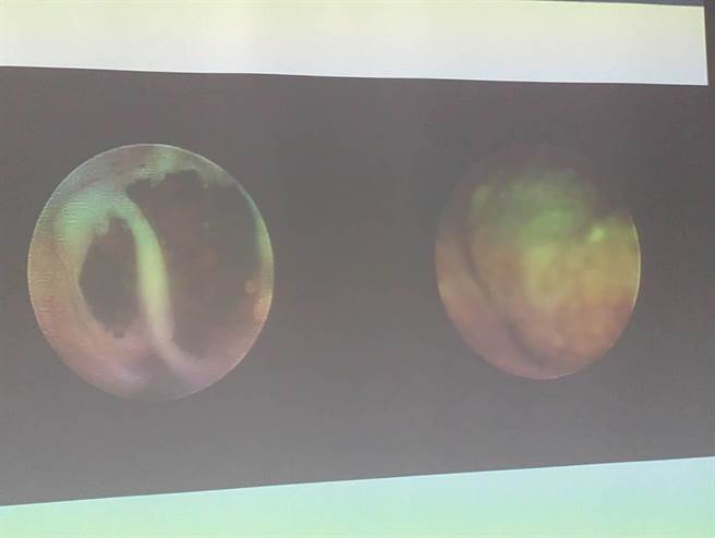 透过输尿管镜发现，老翁两侧输尿管都被肾结石紧紧卡住，才导致严重感染，引发败血症。（翻摄照片／张志康基隆传真）