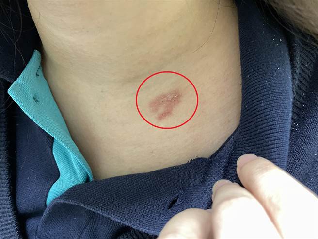 潘小姐确诊又长皮蛇，直呼比确诊新冠肺炎还折磨人。（乌日林新医院提供）