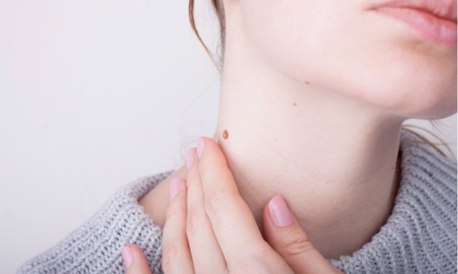 医师提醒，如果发现痣有变大、边缘不规则、色素不均等状况，一定要就医检查。（示意图／Shutterstock）