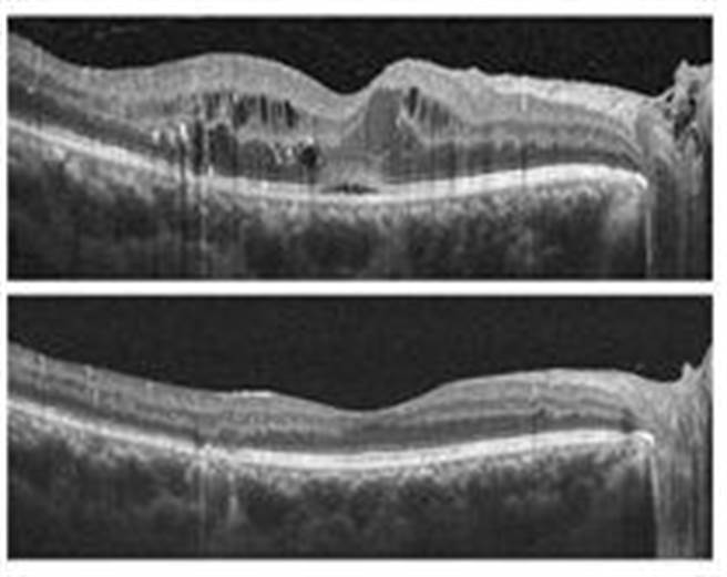 糖尿病黄斑部水肿治疗前（上图）、后（下图）之光学相干断层扫描（OCT）比较。治疗后中间水肿明显减少。（基隆长庚医院提供／徐佑升基隆传真）