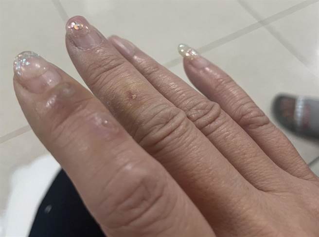该名轻熟女手指遭魔鬼毡划伤，后因照护不当险酿蜂窝性组织炎。（孙英哲摄）