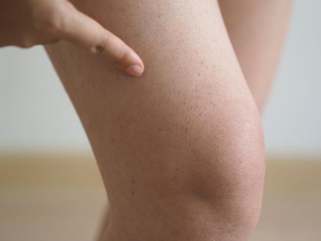 一名高中生的四肢常莫名出现红斑，且口中常感觉到血味，医师表示，这是血小板低下症，因身体容易出血，严重会造成脑出血。 (示意图/ Shutterstock )