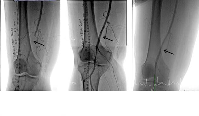 57岁叶姓女子术前及术后1年影像。（丰原医院提供）