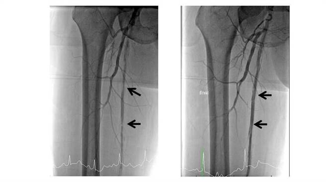 61岁朱姓男子术前及术后影像。（丰原医院提供）
