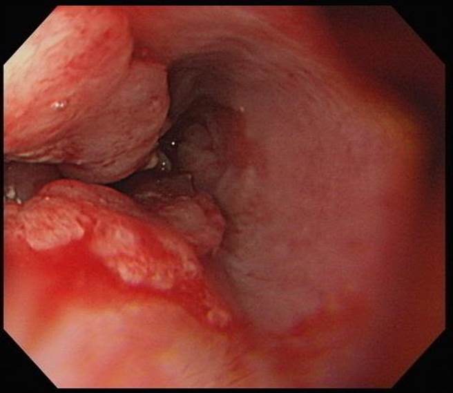从事农产品运输业的「阿鸿」现年47岁，菸酒、槟榔来者不拒，竟期发现罹患食道癌第3期，先经手术切除后，持续与病魔对抗中。（亚大附医提供／潘虹恩台中传真）