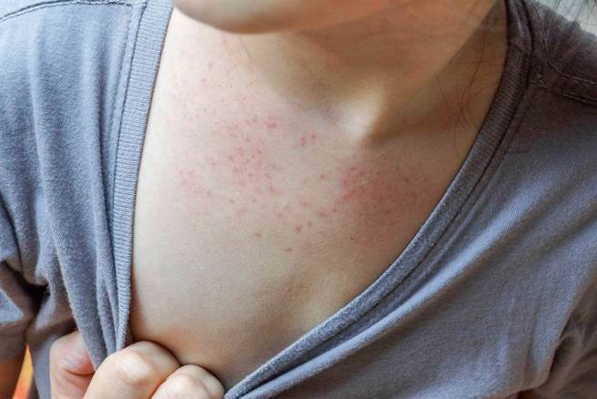 一名15岁女生到餐厅吃海鲜，回家后，身上出现一块块的红疹，在脸上，手脚也都有出现这些浮肿的红疹，而且非常痒。（示意图/ Shutterstock ）
